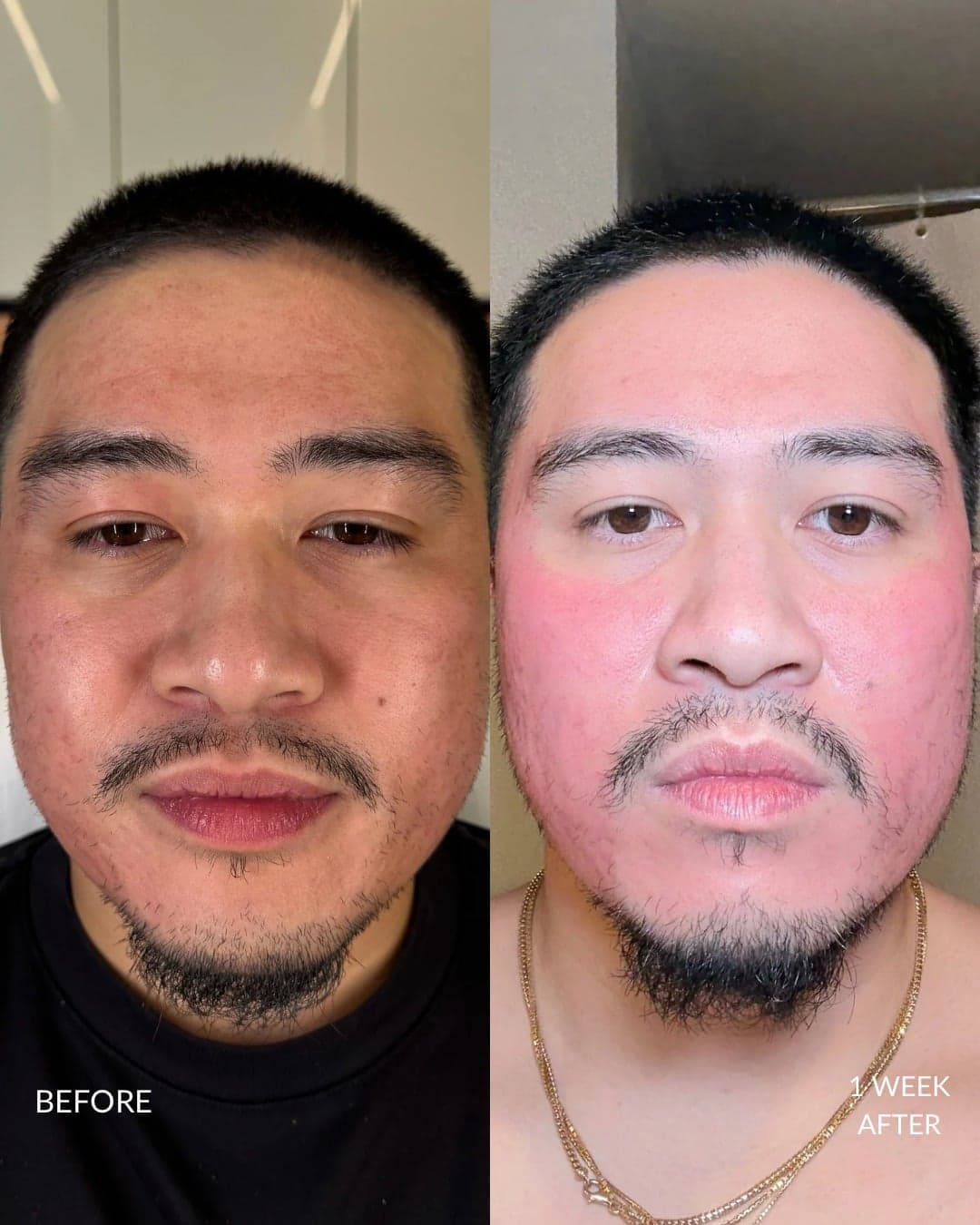 Acne Scar Treatment Before and After