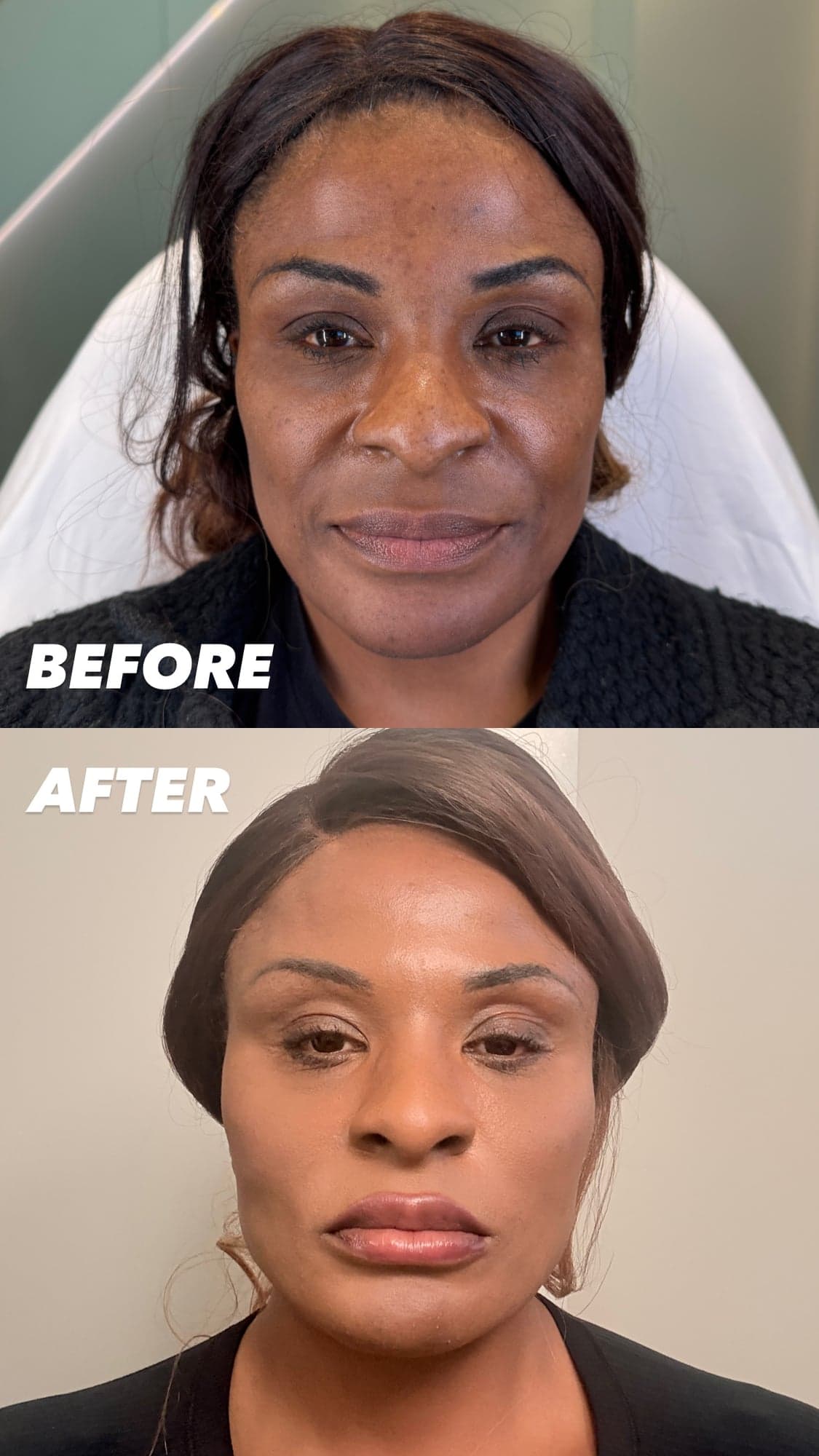Female Facial Sculpting — before and after